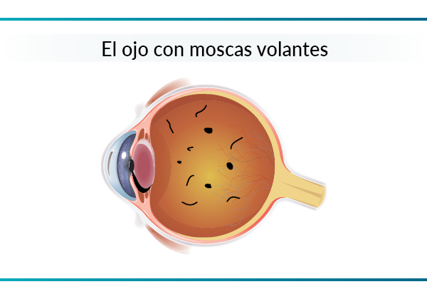 Sección del ojo con dibujo de moscas flotantes